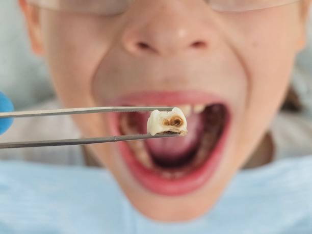 Best Emergency Wisdom Teeth Removal in Weaverville, CA